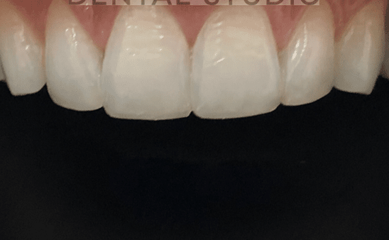 After - Hampstead Dental Studio