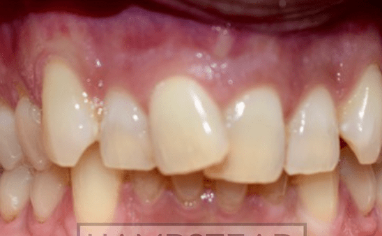 Before - Hampstead Dental Studio