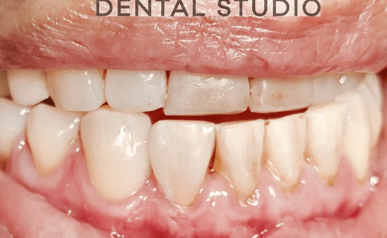 After - Hampstead Dental Studio
