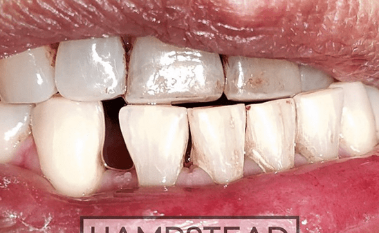 Before - Hampstead Dental Studio