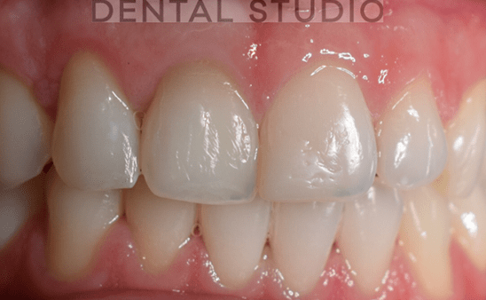 After - Hampstead Dental Studio