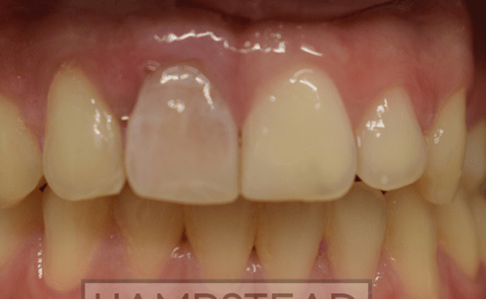 Before - Hampstead Dental Studio
