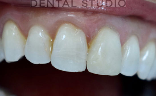 After - Hampstead Dental Studio