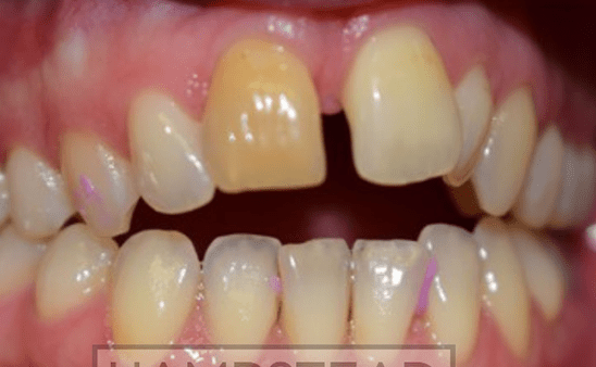 Before - Hampstead Dental Studio
