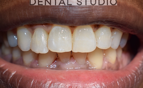 After - Hampstead Dental Studio