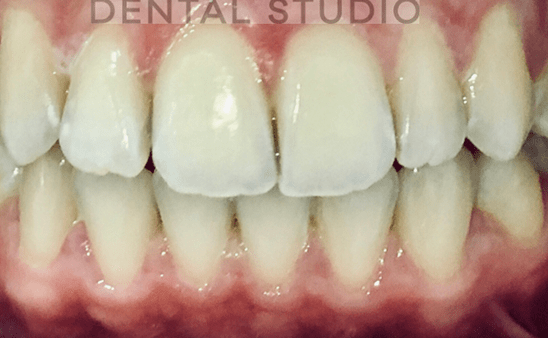 After - Hampstead Dental Studio