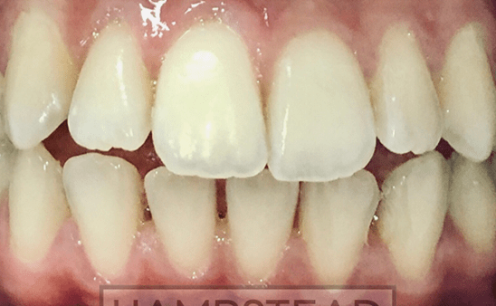 Before - Hampstead Dental Studio