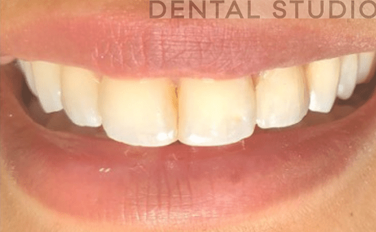 After - Hampstead Dental Studio