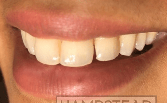 Before - Hampstead Dental Studio