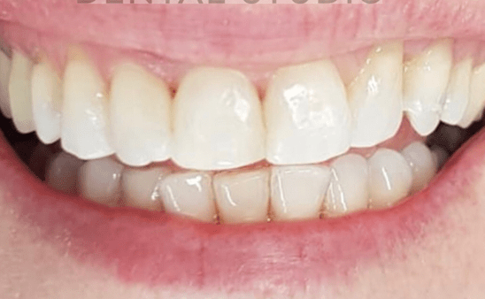 After - Hampstead Dental Studio
