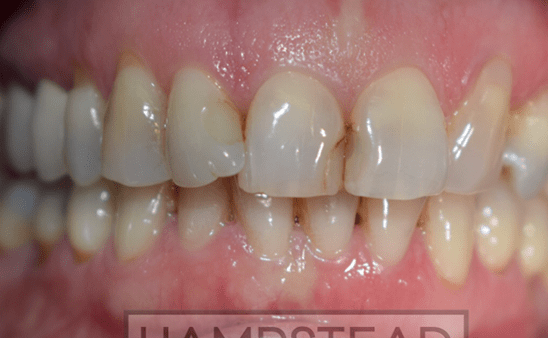 Before - Hampstead Dental Studio