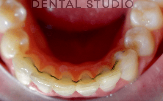After - Hampstead Dental Studio